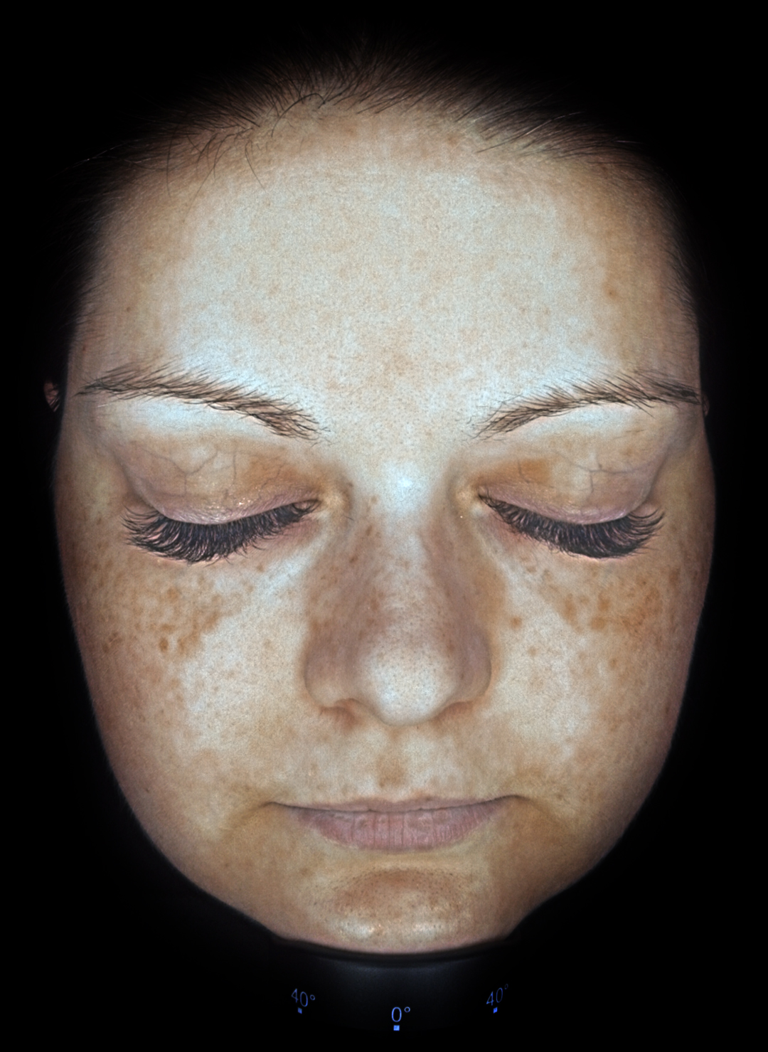 Hautanalyse-Pigmentierung