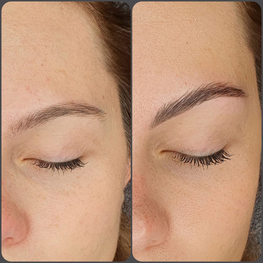 Brow Lifting vorher_nachher