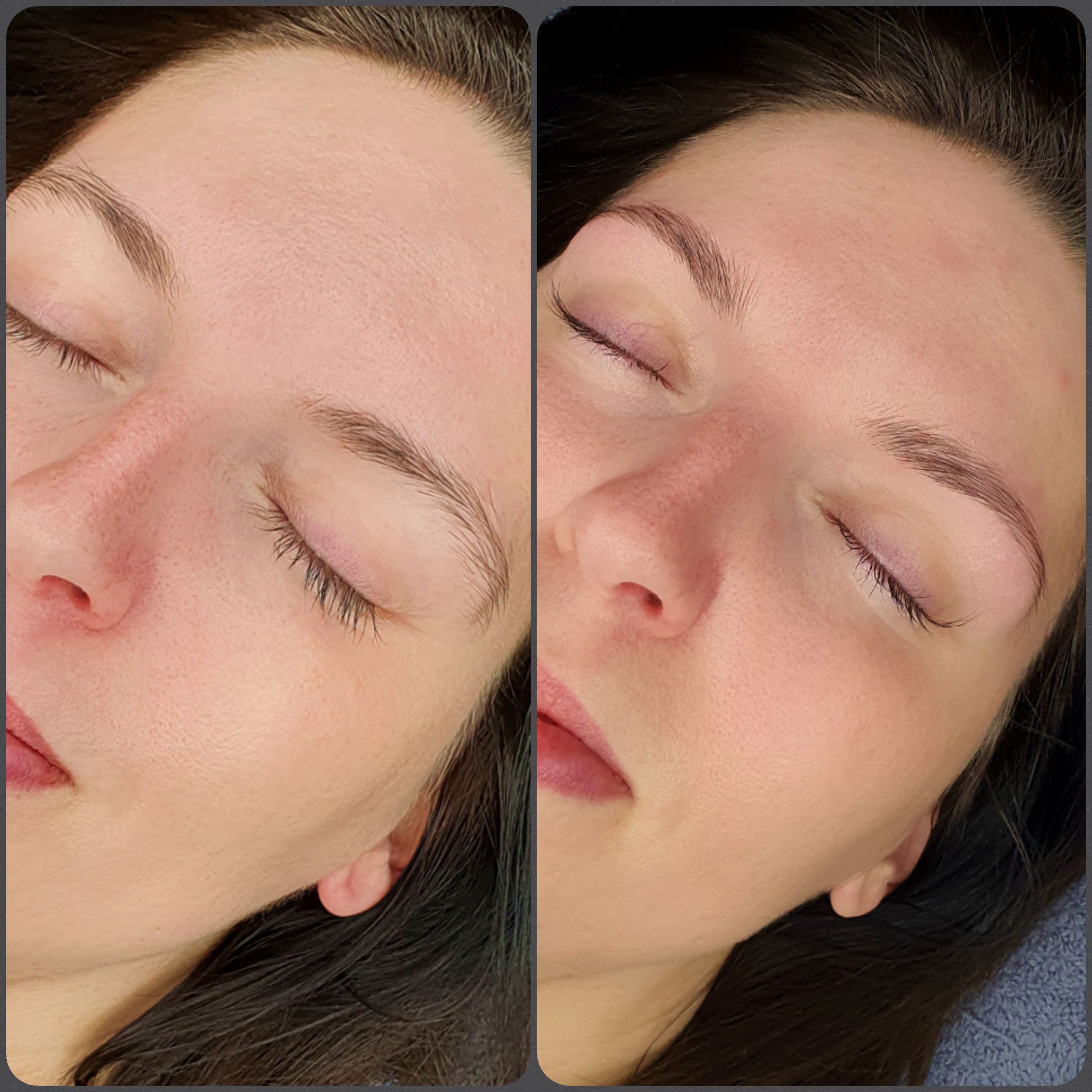 Brow Lifting vorher_nachher