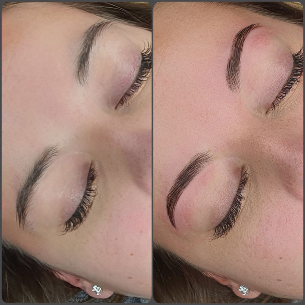 Brow Lifting vorher_nachher
